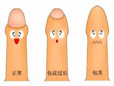 「贴士」包皮过长都要割吗?多大可以割?