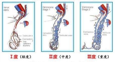 精索静脉曲张病因,预防精索静脉曲张,治精索静脉曲张,精索静脉曲张危害,精索静脉曲张影响
